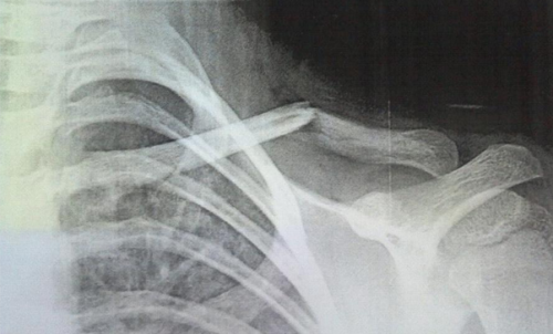 Asias-broken-collarbone-November-20121-e1355179939273